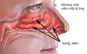 viêm mũi dị ứng là bệnh như thế nào?