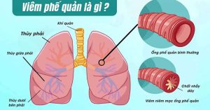 phân biệt viêm phổi và viêm phế quản