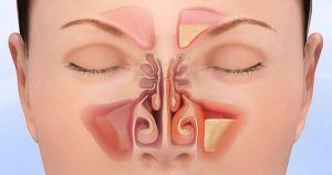 Điểm danh các bệnh về mũi phổ biến