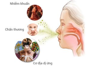 Viêm mũi dị ứng: Nguyên nhân và cách phòng ngừa