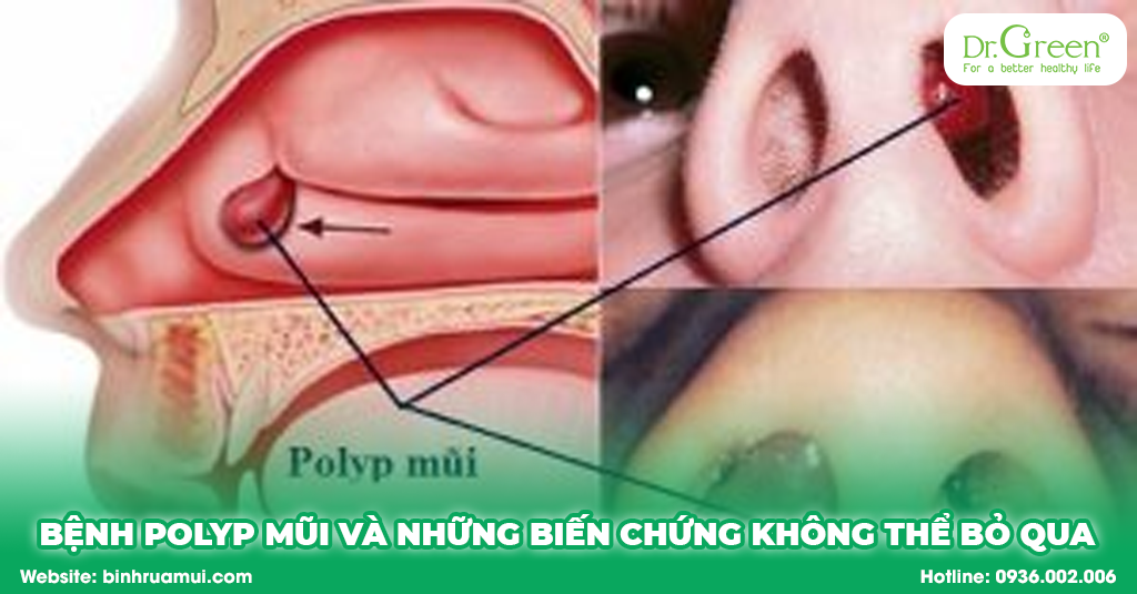 Bệnh polyp mũi có nguy hiểm không? Các biến chứng polyp mũi là gì?