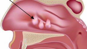 liệu poly mũi có thể tự biến mất không? những cách điều trị poly mũi triệt để là gì?