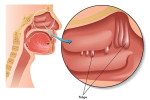 poly mũi gây ảnh hưởng tới quá trình hô hấp 