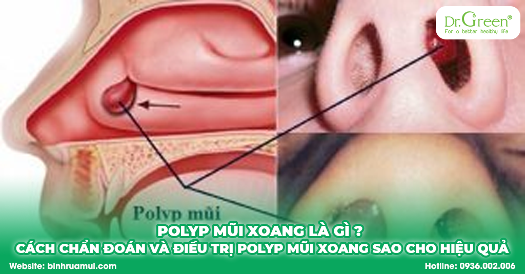 polyp mũi xoang là gì Cách chẩn đoán và điều trị polyp mũi xoang sao cho hiệu quả